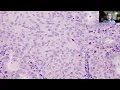 Tip-67 Atypical Polypoid Adenomyoma