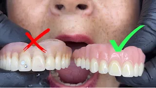 Por qué debes cambiar tu prótesis dental cada 3 años ?