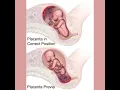 Podcast 740 Placenta Previa