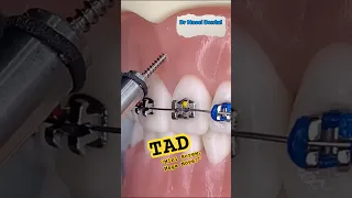 Mini Screw Mega Move TAD Braces
