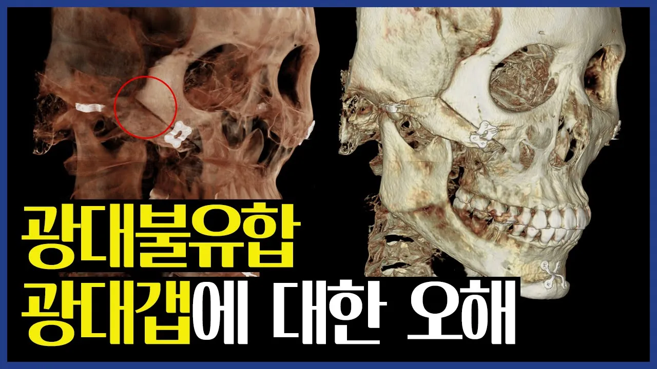 광대불유합, 광대갭이 있으면 무조건 재수술해야 할까?