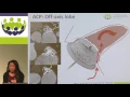 Jacqueline Saw - Assessment implications and management of residual leaks after LAA occlusi