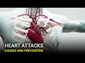 Download Lagu Heart Attacks: Causes and Prevention