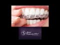 Invisalign Commack NY - Michael Kampourakis DDS
