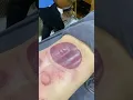 Download Lagu [ASMR] Chinese Cupping Therapy   With Super Big Cup #asmr #massage #youtubeshorts #cupping #video
