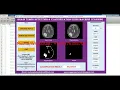 Brain Tumor Detection Using Machine Learning With Source Code Matlab Project Tumor Detection