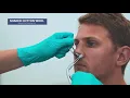 Nasal cautery in Epistaxis