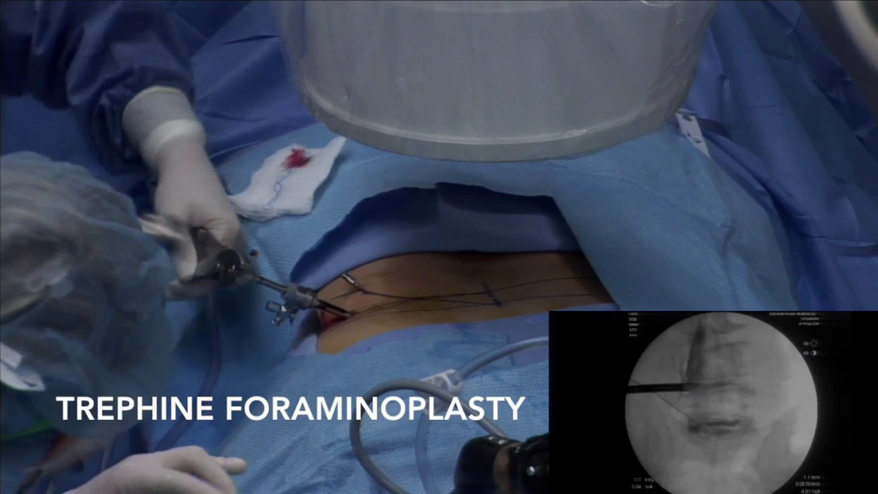 Surgical step by step demonstration of a full endoscopic resection of a L5-S1 disk herniation and bo. 