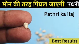गर्मी में पथरी (Kidney Stone) से बचें — 5 आसान उपाय | Pathri Ka Ilaj Hindi