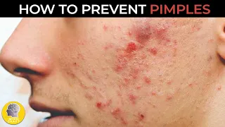 amazing tips to prevent pimples