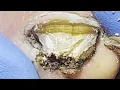 Wow~Onychomycosis Is Wrapped In Black Mud, You Will Be Surprised When You Pull It Out【Pedicure King】