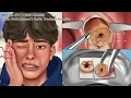Lagu ASMR 매복 사랑니 제거 \u0026 충치치료 풀버전! | 치아미백 | Wisdom Tooth \u0026 Cavity Treatment Animation