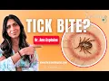 Tick Bite Lyme Disease Symptoms Treatment Bullseye Rash Fever Joint Pain Dr Ann