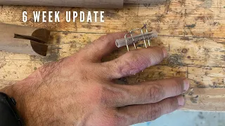 An Update on my Finger Injury - Ring Avulsion