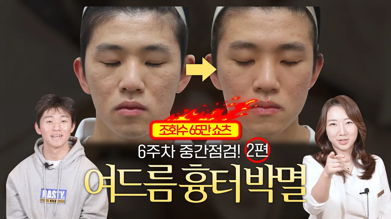 ⭐️이벤트 있음⭐️ 여드름 흉터 치료, 비포 애프터 공개! | 여드름, 여드름치료, 여드름흉터 | 차이의원 조원진 대표원장