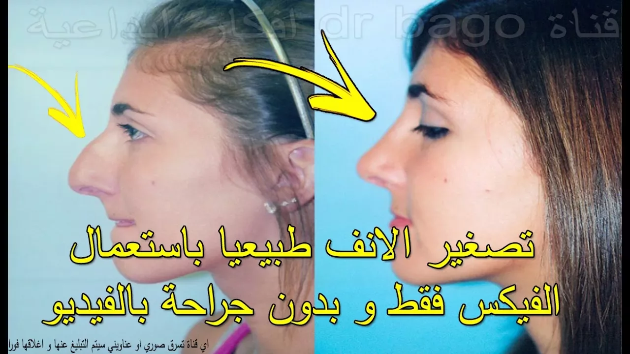 For more info, visit: http://www.nadersaab.com/rhinoplasty-nose-surgery-lebanon.. 