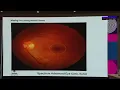 AIOC2026 IC77 Vitreo Retinal Issues Dr Vinit Shah