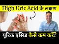 Download Lagu यूरिक एसिड बढ़ने के लक्षण, नार्मल स्तर और उपाय  | यूरिक एसिड बढ़ने पर क्या खाना चाहिए और क्या नहीं?