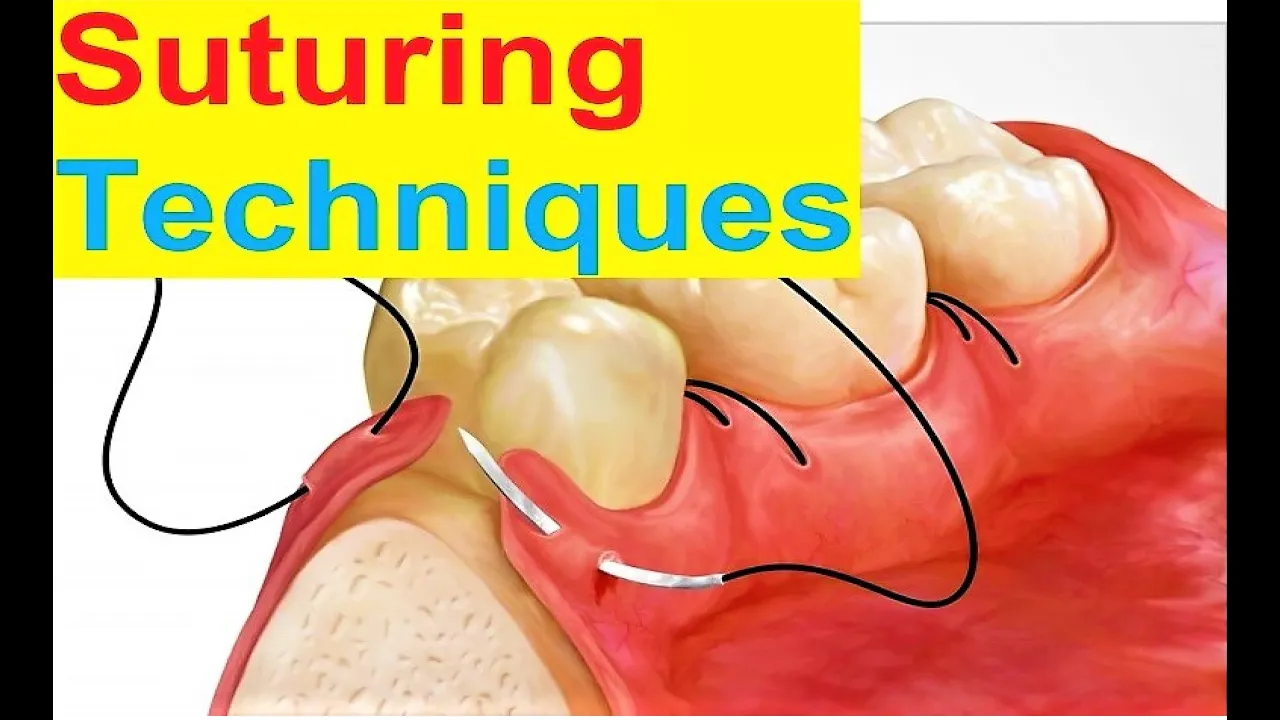Suturing techniques in oral surgery