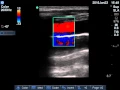 Pleural effusion - Fluid Color sign Probe 15-6 SLaX