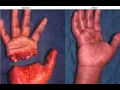 Replantation complete amputation CPT code - simplify medical coding