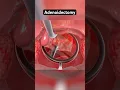 Download Lagu Adenoidectomy explained (3D Animation)