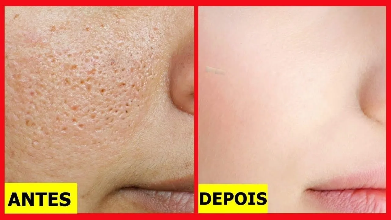 Como limpar os poros em casa | Dica de Esteticista