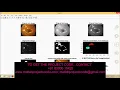 Matlab code for Diagnosis of Diabetic Retinopathy by Detection of Microneurysm And Exudates