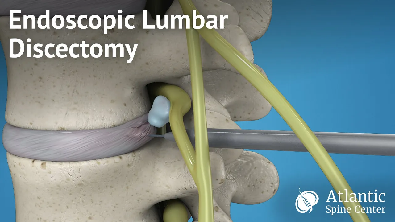 Interlaminar full endoscopic (PELD) resection disc herniation & spur removal, surgical technique. 