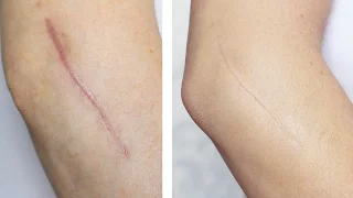 how to cover conceal a scar