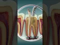 Download Lagu Root Canal Treatment | Curveia Dental I RCT