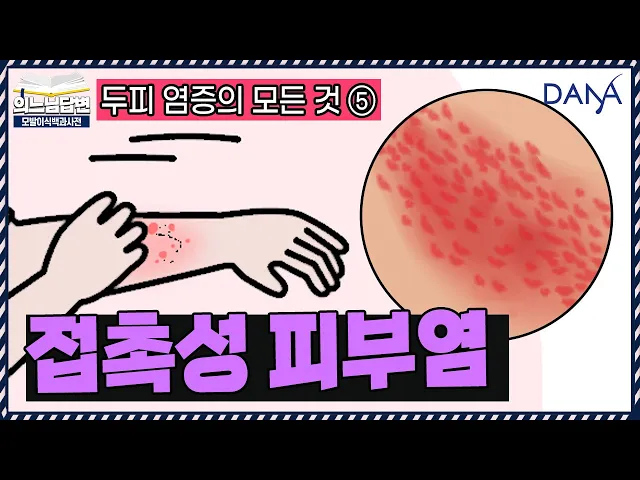 의느님답변📂알레르기가 있다면 '염색약' 주의🚫ㅣ두피 염증의 모든 것⑤ - 접촉성 피부염ㅣ다나성형외과(DANA)ㅣ모발이식ㅣ헤어라인교정ㅣ두피문신ㅣ탈모치료
