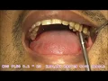 KOS Plus implant placement video