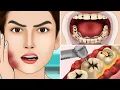 Lagu ASMR Molar Tooth Caries Removal so Satisfying part3 | Dental Care Animation | 어금니 우식증 제거 너무 만족
