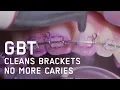 Download Lagu Brackets with GBT - Guided Biofilm Therapy