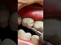 Supragingival dental calculus tartar formation and removal 3D explanation