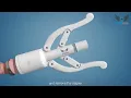 Download Lagu Circumcision Staplers from CLONMED Explained