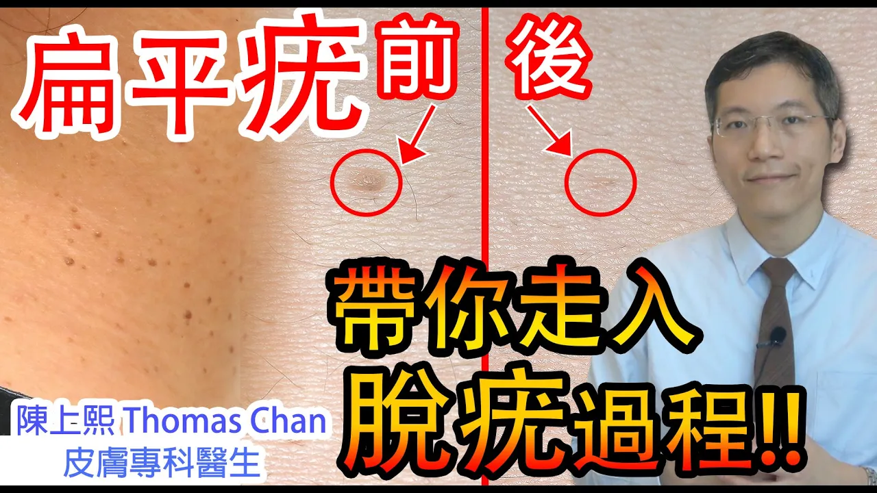 扁平疣 | 脫扁平疣過程大公開 |皮膚專科醫生 | 為甚麼會有扁平疣?| 扁平疣傳染方法?| 皮膚專科醫生講解