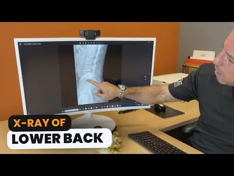 Digital Spinal X-Rays in Delray Beach video