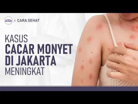Sudah Ada 7 Kasus, Ayo Cegah Cacar Monyet Sebelum Menyebar