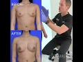 Before and After Breast Augmentation Dr Daniel Barrett Plastic Surgery Beverly Hills