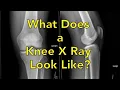 What Does a Knee X Ray Look Like