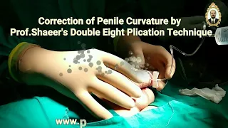 جراحة اعوجاج و تقوس العضو الذكري في مصر بتقنية بروفيسور شعير 