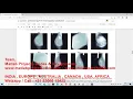 MAMMOGRAM CLASSIFICATION USING DEEP LEARNING CNN PYTHON CODE www matlabprojectscode com