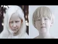 7 Personas Albinas Mas Hermosas Y Unicas Del Mundo