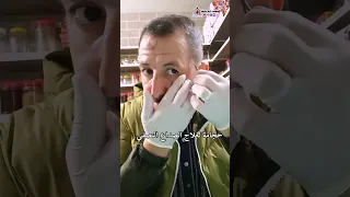 حجامة لعلاح الصداع النصفي والام الشقيقة Cupping الحجامة Hijama 