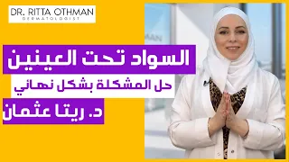 السواد تحت العين   الهالات السوداء إخفاء وعلاج الهالات السوداء تحت العين دندنها