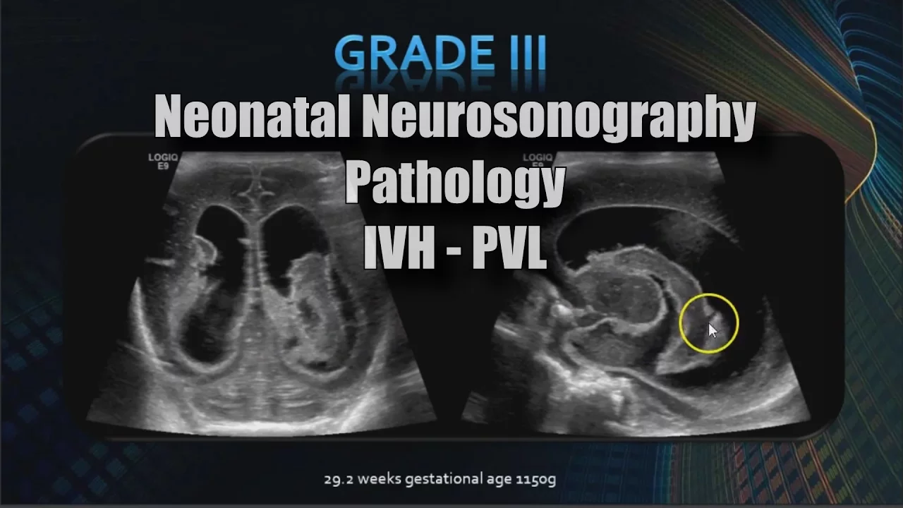 Neonatal Neurosonography | Pathology | IVH - PVL
