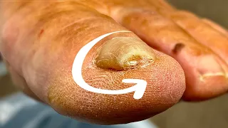 The Pressure Inside This Ingrown Toenail… WOW