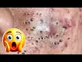 SATISFYING Blackhead Removal Pimple Popping